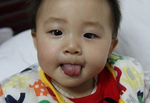 孩子吐字不清是舌头短了吗 哪些情况属于舌系带