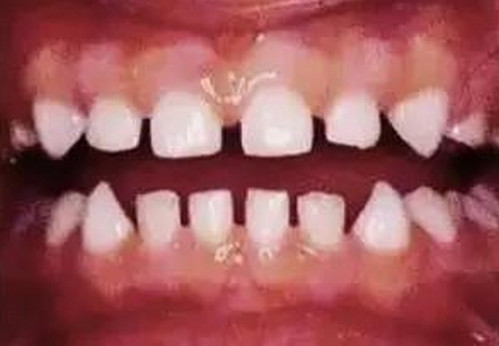 孩子乳牙蛀了怎么回事 乳牙龋齿形成的原因