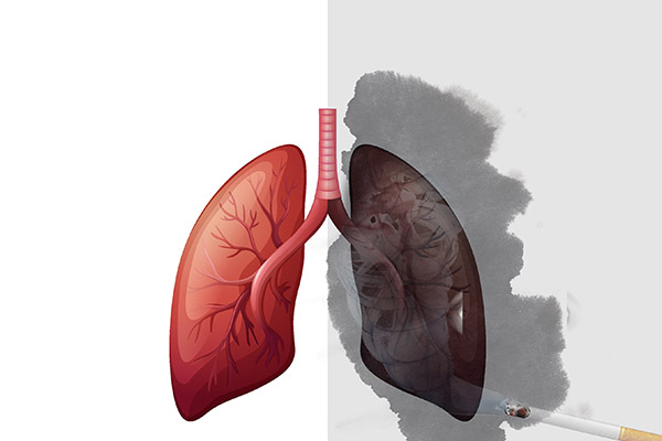 肺癌早期症状 肺癌有哪些早期症状