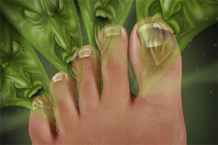 女人脚臭常见的原因以及治疗的方法