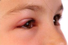 红眼病的传播途径以及预防方法