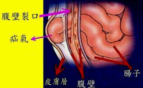 小儿疝气4大常见类型有哪些