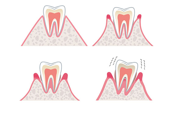 牙周炎怎么治疗 治疗牙周炎的方法