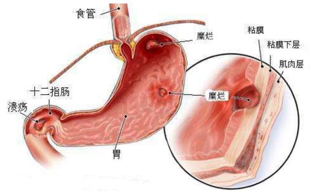 消化性溃疡分为哪些不同的类型会有哪些表现