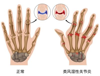 类风湿关节炎高发人群存在着哪些特性