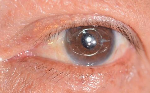 遗传也会导致黑眼圈 这5招让你快速去黑眼圈