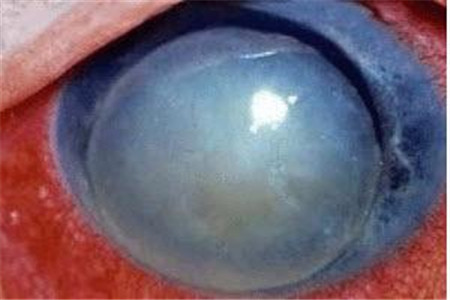 春季护眼警惕青光眼的早期症状