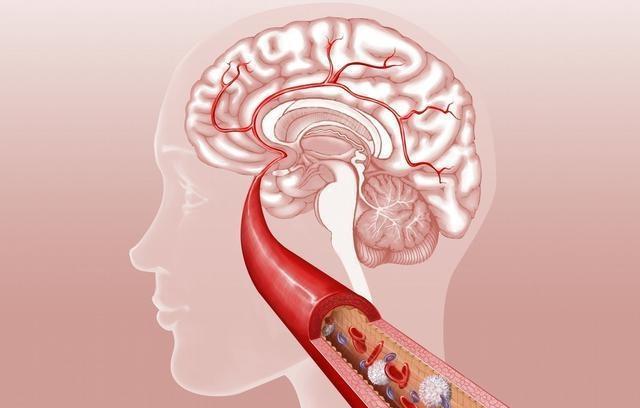 脑血栓患者吃哪些种类药治疗效果好