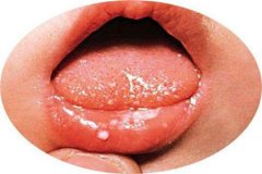 谨防口腔癌的四个早期症状
